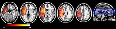 Recovery of Apraxia of Speech and Aphasia in Patients With Hand Motor Impairment After Stroke